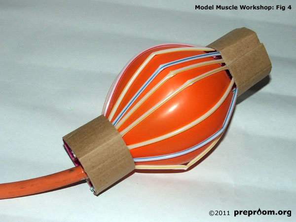 Fig 4: Balloon is inserted into the tube and inflated